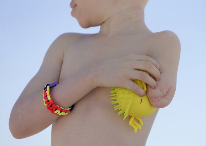 Mwigulu Magesa holds a water toy between his body and his amputated left arm while playing on a beach in Long Beach Island, N.J. on Wednesday, July 22, 2015. One out of every 1,400 citizens in Tanzania has albinism. Mwigulu was attacked and dismembered in Tanzania because of a belief that his body parts will bring wealth. (AP Photo/Julie Jacobson)