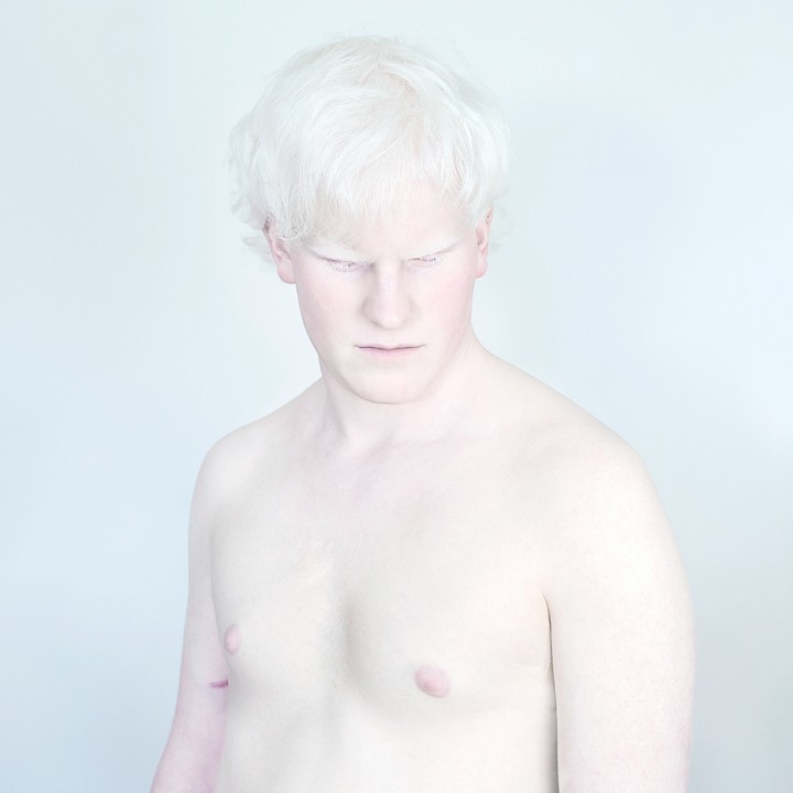 Sanne De Wilde albinos