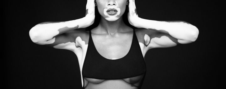 Chantelle Brown-Young vitiligo