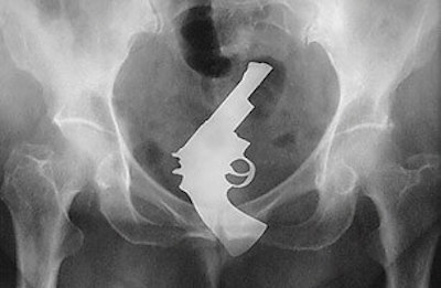 objet rectum revolver
