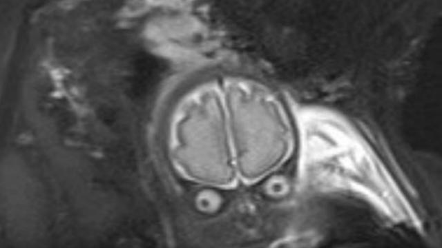 IRM du cerveau de son bébé