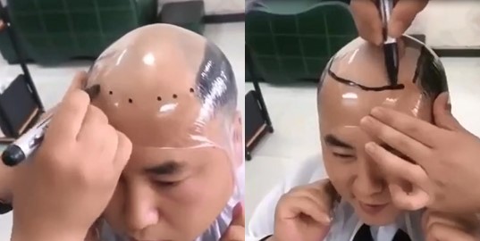 Retrouvez une belle chevelure à la place d’un crâne chauve avec cette technique
