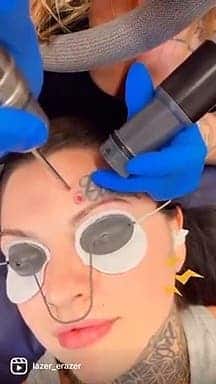 Une jeune femme se fait supprimer ce tatouage dont elle avait honte