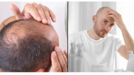 Les scientifiques découvrent un «remède contre la calvitie» grâce au «gène de l'homme des cavernes»