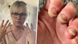 Cette jeune femme qui se faisait faire les ongles en gel pendant des années se retrouve paralyser des mains !