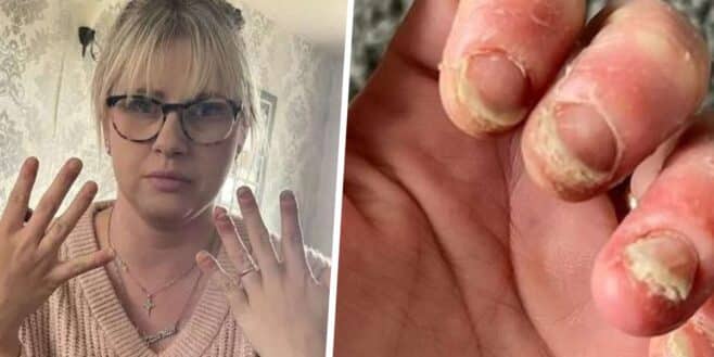 Cette jeune femme qui se faisait faire les ongles en gel pendant des années se retrouve paralyser des mains !