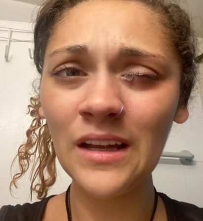 TikTok : une influenceuse dans un état grave après avoir confondu de la colle avec ses gouttes pour les yeux !