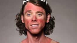 Coup de soleil ce geste que l'on fait tous est très dangereux pour la santé !