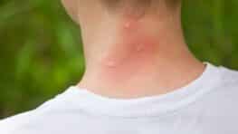 Moustiques voici enfin pourquoi certaines personnes les attirent plus que d'autres !