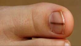 Si vous avez ce trait noir sur les ongles il faut vite allez chez votre docteur