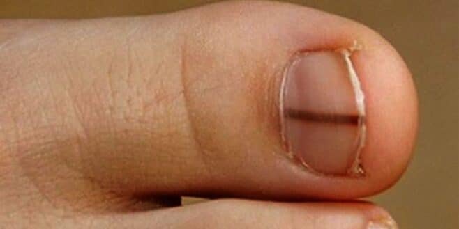 Si vous avez ce trait noir sur les ongles il faut vite allez chez votre docteur