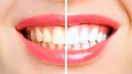 3 astuces complètement naturelles pour avoir des dents blanches