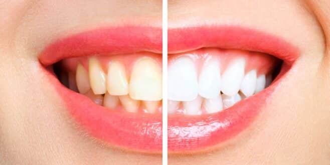 3 astuces complètement naturelles pour avoir des dents blanches