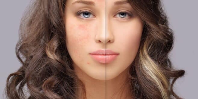 Des dermatologues dévoilent enfin l'impact du maquillage sur l'acné