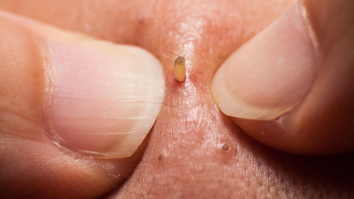 L’astuce d’une dermatologue pour se débarrasser de tous les points noirs le nez