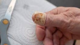 La meilleure astuce de grand-mère pour soigner les panaris