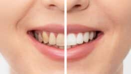 Les dents jaunes c'est fini avec un seul ingrédient de cuisine