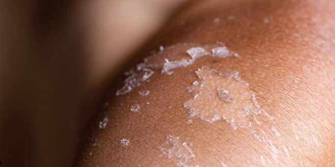 Les meilleures astuces pour ne pas peler après un coup de soleil