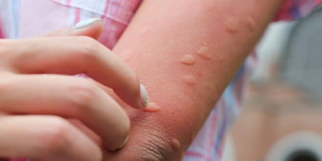 Ces astuces magiques pour calmer les piqûres de moustiques et les démangeaisons
