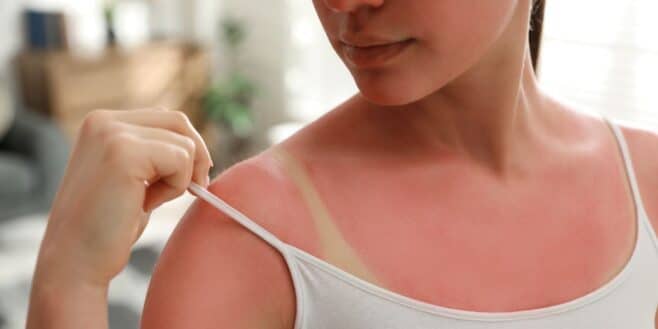 Cette mauvaise habitude de beaucoup après un coup de soleil est très dangereuse pour la peau