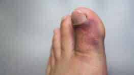 Vous avez des bleus qui tardent à disparaître ? Voici à quel moment il faut vraiment s’inquiéter