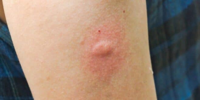 Vous pensez qu’il ne s’agit que d’une simple piqûre de moustique ? Voici le syndrome de Skeeter, bien plus dangereux qu’il n’y paraît