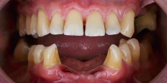 « J’ai rêvé que mes dents tombaient » : ce que ça dit vraiment de vous selon les psychologues