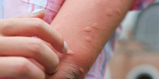 « Je me fais piquer tout le temps » : la vraie raison pour laquelle les moustiques vous choisissent
