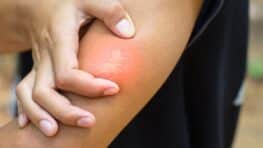 La piqûre de cet animal est pire que celles des guêpes et des frelons asiatiques