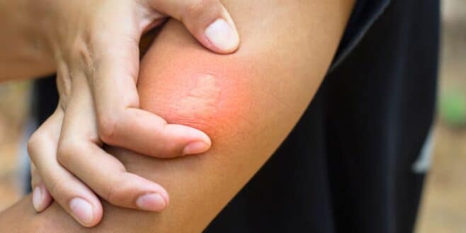 La piqûre de cet animal est pire que celles des guêpes et des frelons asiatiques