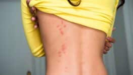 Punaises de lit : ces signes pour reconnaître facilement une piqûre