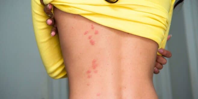 Punaises de lit : ces signes pour reconnaître facilement une piqûre